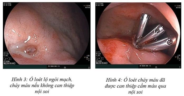 16 tuổi đã xuất huyết dạ dày và cảnh báo từ bác sĩ- Ảnh 1.