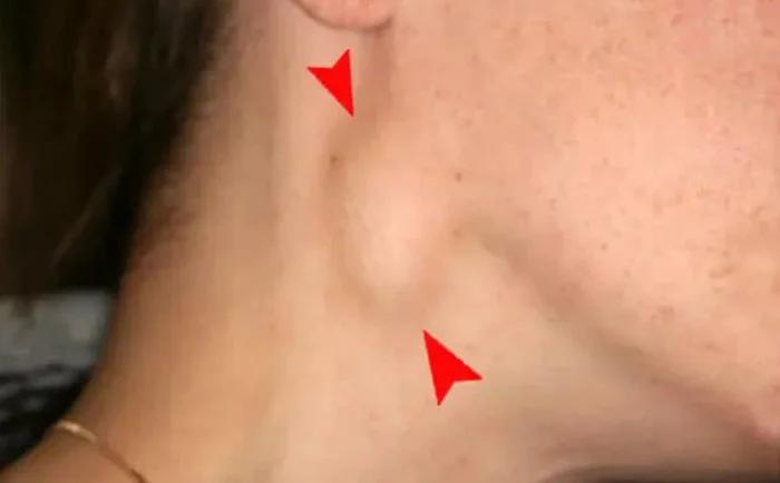 Dấu hiệu cảnh báo ung thư vòm họng tuyệt đối không nên bỏ qua- Ảnh 2.