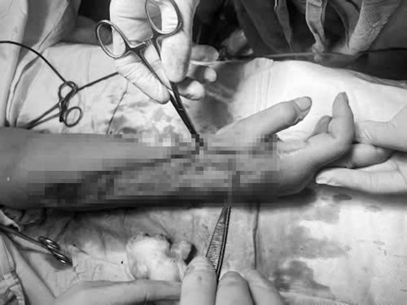 Người phụ nữ có nguy cơ bị cụt cẳng tay khi dựng cây nêu đón Tết- Ảnh 2.