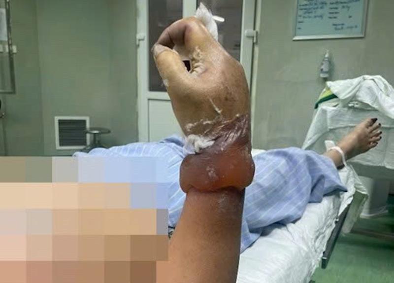 Người phụ nữ có nguy cơ bị cụt cẳng tay khi dựng cây nêu đón Tết- Ảnh 1.