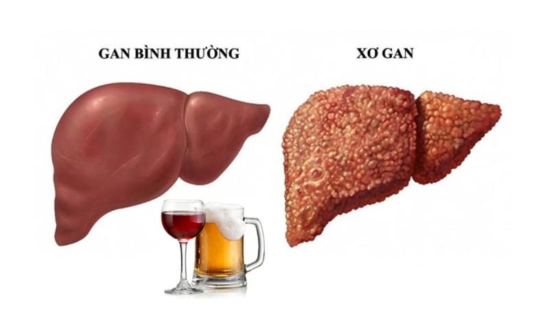 Bệnh gan tăng vọt sau Tết: Chuyên gia chỉ rõ thói quen "gánh nặng" nội tạng- Ảnh 1.