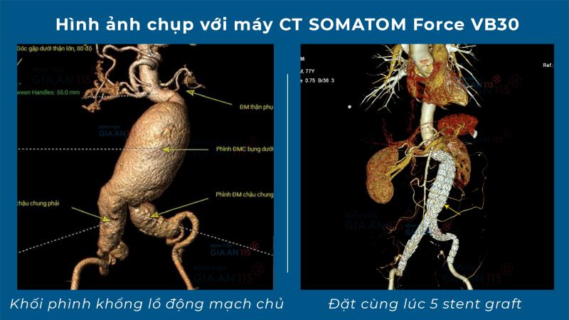Đau bụng thông thường, vào bệnh viện đặt khẩn 5 stent cùng lúc- Ảnh 1.