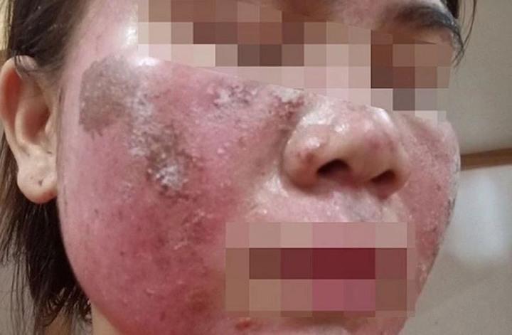 'Vỡ mộng' da đẹp đón Tết: Tan nát mặt vì tự peel da theo hướng dẫn trên mạng- Ảnh 1.