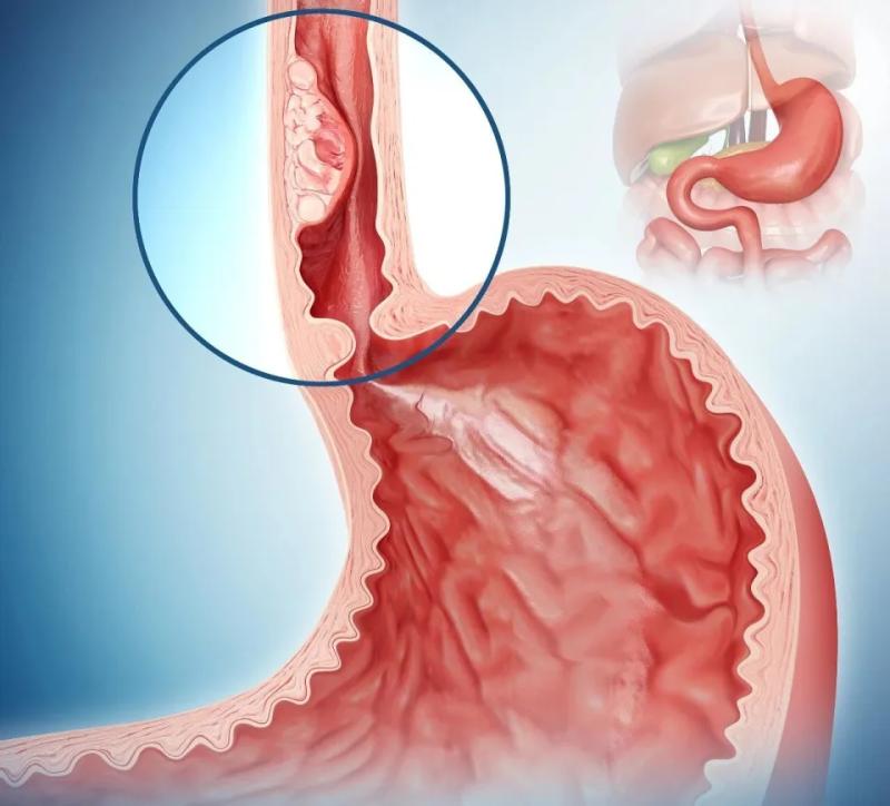 Mắc 2 loại ung thư trong 3 năm, người đàn ông ân hận: 