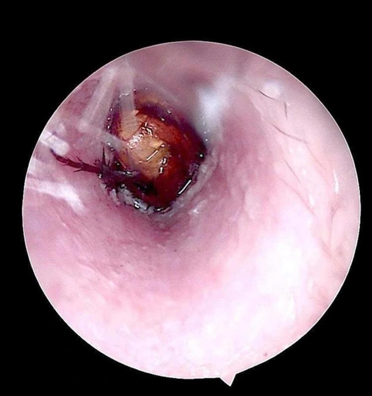 Cháu bé đau tai dữ dội, bác sĩ sốc ngang phát hiện bí mật "đáng sợ" bên trong- Ảnh 1.
