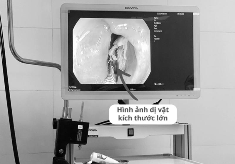 Bệnh nhân 16 tuổi đau họng kéo dài, bác sĩ phát biện bí mật "đáng sợ" bên trong- Ảnh 1.