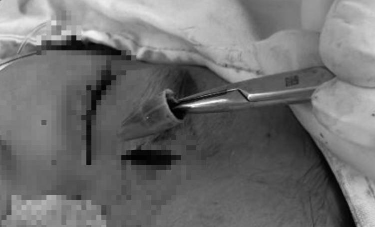 Bé trai đau vùng mắt dữ dội, bác sĩ sốc khi phát hiện dị vật "tàng hình"- Ảnh 1.