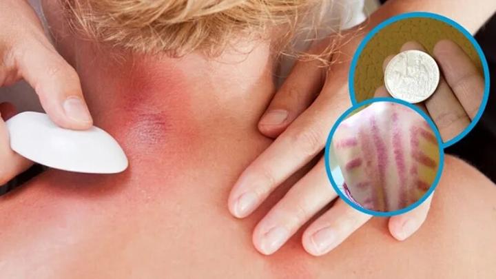Vì sao đau mỏi người, 'trúng gió' dùng đồ bạc, trứng gà để cạo gió?- Ảnh 1.