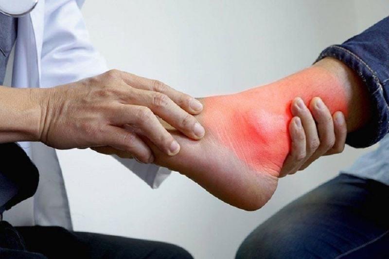 Cơn gút cấp rình rập trên mâm cỗ Tết- Ảnh 2.