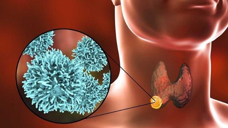 Nhiều người đi siêu âm phát hiện có nang giáp, bác sĩ chỉ ngay 5 dấu hiệu cảnh báo cần đi khám lại ngay lập tức- Ảnh 1.