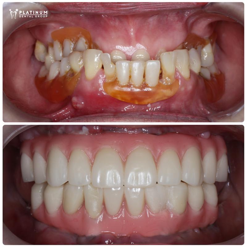 Những ca mất răng và hành trình phục hình đầy ngoạn mục- Ảnh 2.