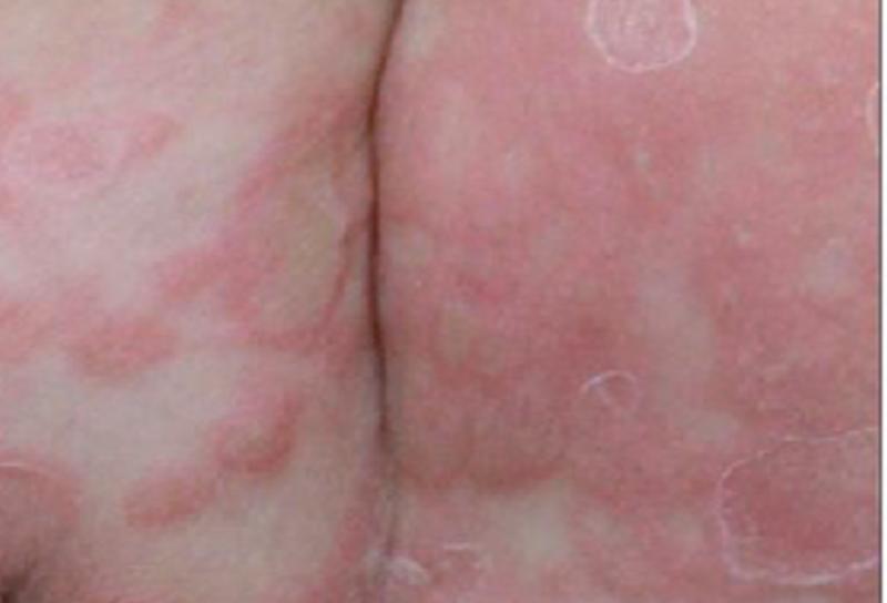 Bé trai 3 tuổi bị giang mai bẩm sinh dù không có triệu chứng- Ảnh 2.