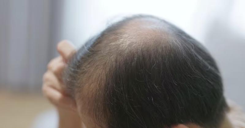 Hàng triệu người bị hói sớm chỉ vì 1 thói quen vô cùng phổ biến- Ảnh 2.