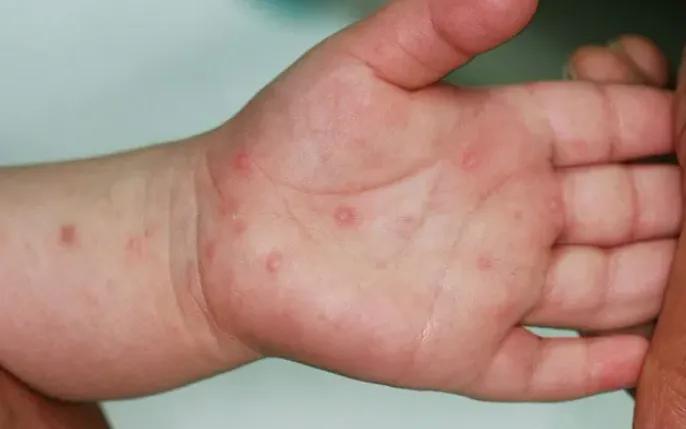 Hà Nội: Ca sốt xuất huyết giảm, bệnh tay chân miệng tăng- Ảnh 1.