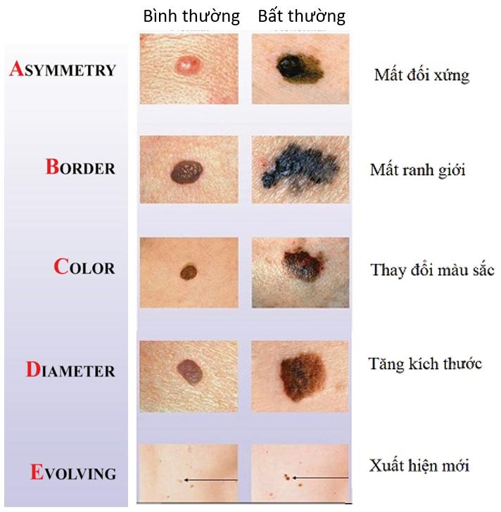 Ung thư da: Nguy hiểm tiềm ẩn từ những tổn thương không đau, không ngứa- Ảnh 1.