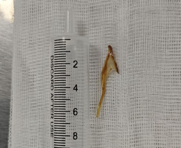Tưởng bị trĩ hóa ra xương gà dài 3cm mắc ở hậu môn- Ảnh 1.