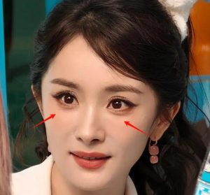 Bị nhăn mắt nhiều thì nên dùng Hifu hay Thermage?