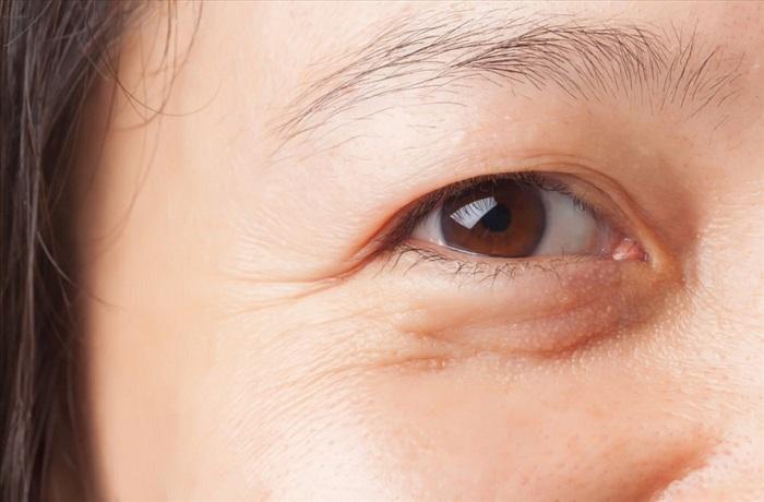 Bị nhăn mắt nhiều thì nên dùng Hifu hay Thermage?- Ảnh 2.