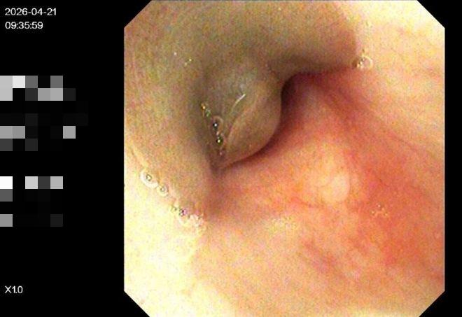 Bé trai 8 tuổi ho ra máu suốt 10 ngày, bác sĩ gắp được "thủ phạm" hút máu dài 8cm đang ngo ngoe bò trườn - Ảnh 2.