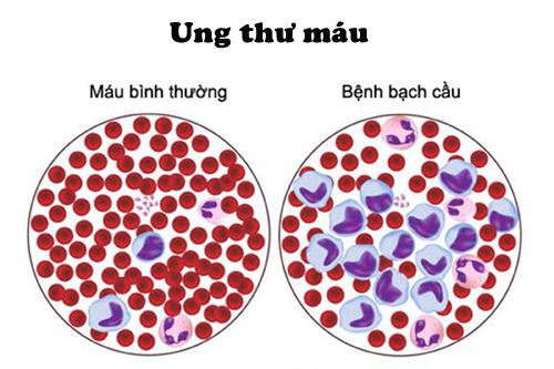 TikToker Đan Thy thông báo mắc ung thư máu ở tuổi 23: Ung thư máu có chữa được không?- Ảnh 3.