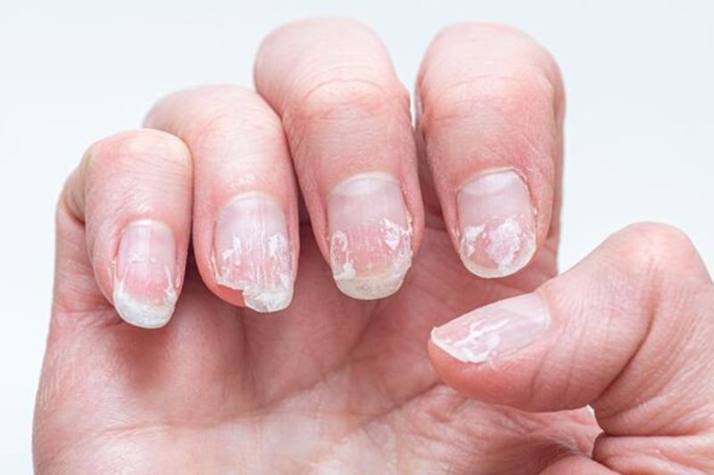 6 bất thường trên móng tay có thể đang “tố cáo” bệnh trong cơ thể bạn - Ảnh 1.