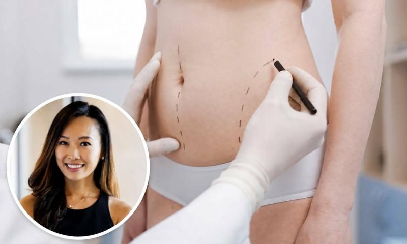 Hút mỡ ra ngoài rồi đem cấp đông bảo quản, đợi chờ làm đẹp trong tương lai: Cảnh báo trào lưu tiềm ẩn rủi ro- Ảnh 2.