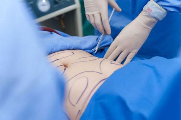 Hút mỡ ra ngoài rồi đem cấp đông bảo quản, đợi chờ làm đẹp trong tương lai: Cảnh báo trào lưu tiềm ẩn rủi ro- Ảnh 1.