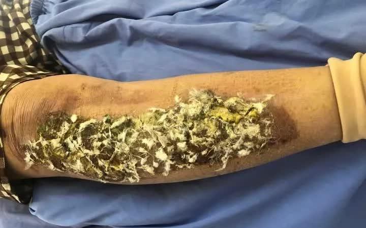 Nguy cơ nhiễm trùng khi... đắp lông chim lên vết bỏng - Ảnh 1.