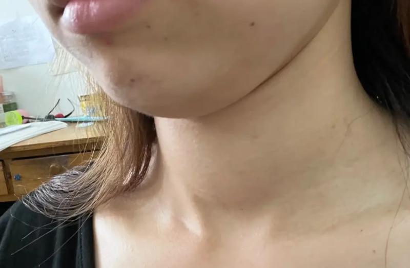 Người phụ nữ 36 tuổi sống lành mạnh, KHÔNG rượu hay thuốc vẫn mắc suy giáp, bác sĩ: 4 món ngon này ăn ít đi! - Ảnh 1.
