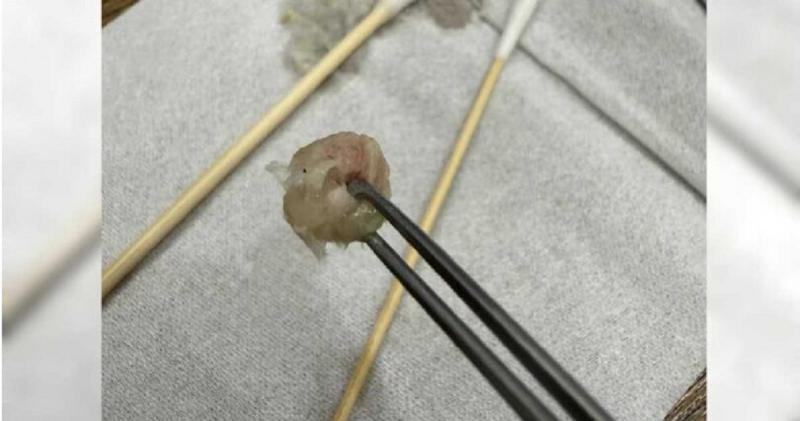 Bé gái 6 tuổi đau khổ vì nghẹt mũi, sự thật bên trong khiến bố mẹ "hoảng sợ" - Ảnh 1.