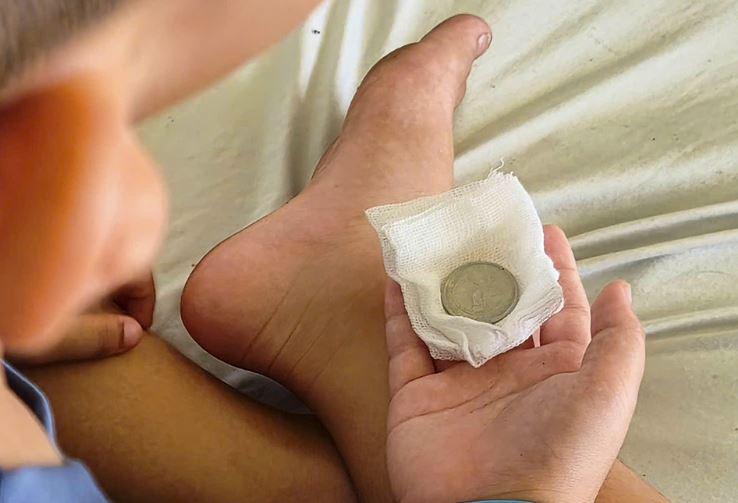 Bé trai 7 tuổi liên tục nôn ói, bác sĩ gắp ra thứ "đáng sợ" bên trong - Ảnh 2.