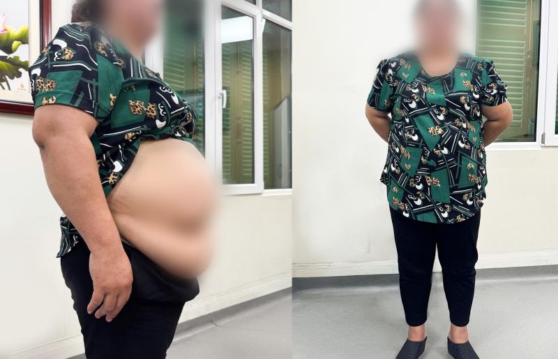 Nặng 101kg và 10 lần mang thai dang dở, người phụ nữ quyết cắt nhỏ dạ dày- Ảnh 1.