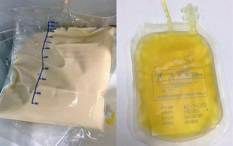 Cô gái 27 tuổi máu đục như trà sữa và "ngập dầu" vì kiểu ăn tiện lợi của nhiều người Việt trẻ - Ảnh 2.