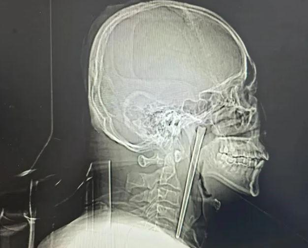 Đau nhói mắt trái, người đàn ông 50 tuổi sốc nặng khi bác sĩ gắp ra thứ "đáng sợ" dài 12cm - Ảnh 2.