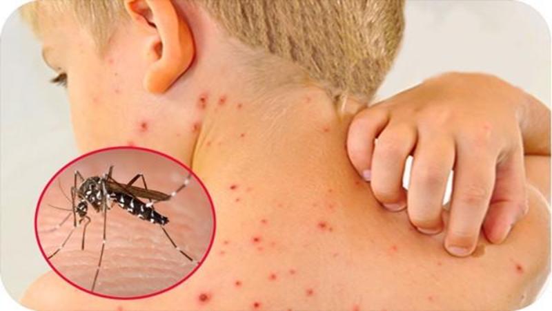 Dịch sốt xuất huyết tăng cao, chuyên gia cảnh báo biến chứng nặng của bệnh - Ảnh 1.