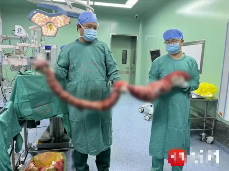 Người đàn ông 4 tháng không đi đại tiện, bụng phình to như "mang thai", bác sĩ lấy ra thứ "đáng sợ"- Ảnh 2.