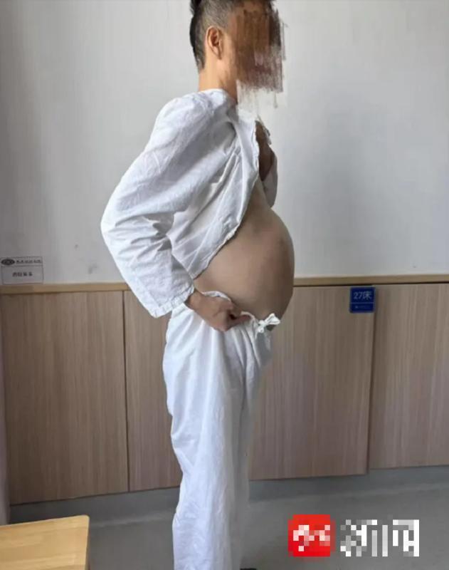 Người đàn ông 4 tháng không đi đại tiện, bụng phình to như "mang thai", bác sĩ lấy ra thứ "đáng sợ"- Ảnh 1.