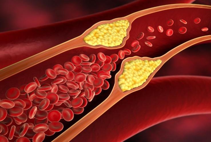 Học người Nhật cách "quét rác" cho mạch máu bằng 3 thực phẩm quen đến ngỡ ngàng - Ảnh 1.