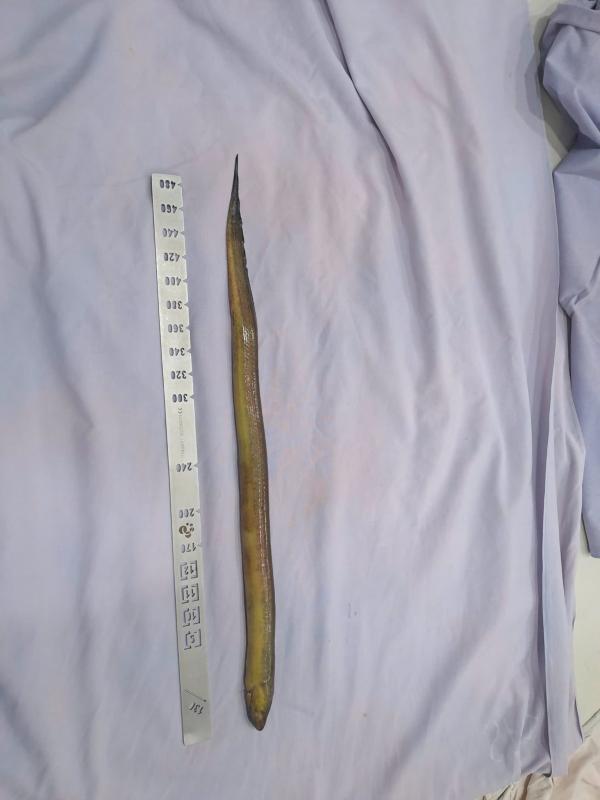 Lươn dài 50cm chọc thủng trực tràng, nằm ngoe nguẩy trong ổ bụng bệnh nhân- Ảnh 1.