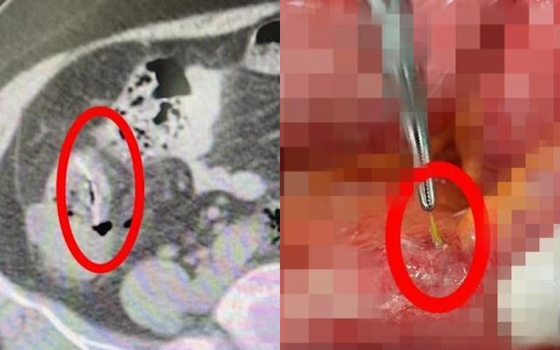 Nuốt miếng cơm to để chữa hóc xương cá, người phụ nữ suýt mất mạng, cả đời phải dùng hậu môn nhân tạo - Ảnh 2.
