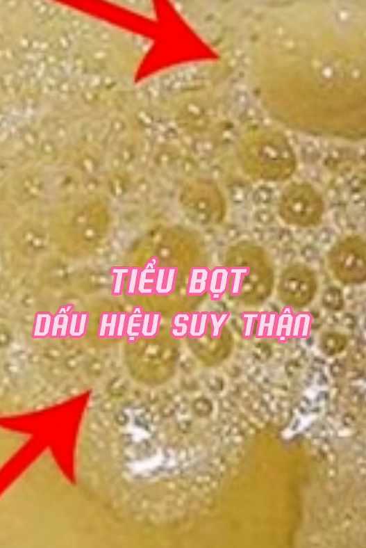 Đừng lên TikTok tìm câu trả lời, nếu thấy nước tiểu có những dấu hiệu này thì cần đi khám ngay kẻo hỏng thận- Ảnh 1.