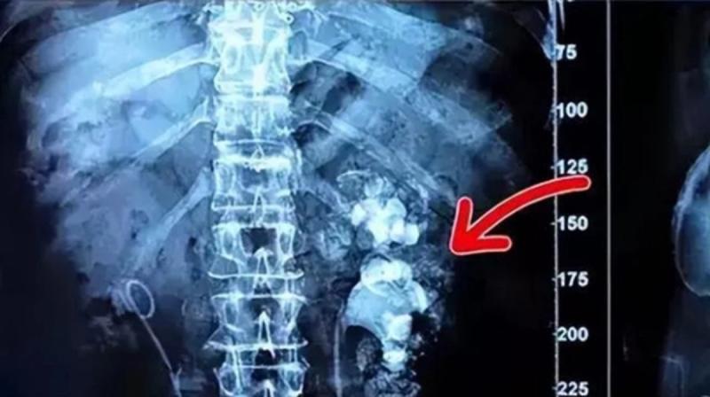 Uống loại nước "vạn người mê", cô gái "sốc" khi phát hiện sỏi thận "phủ kín" hai bên thận - Ảnh 1.