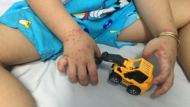Sốt xuất huyết, tay chân miệng tăng trong tháng 4 - Ảnh 1.