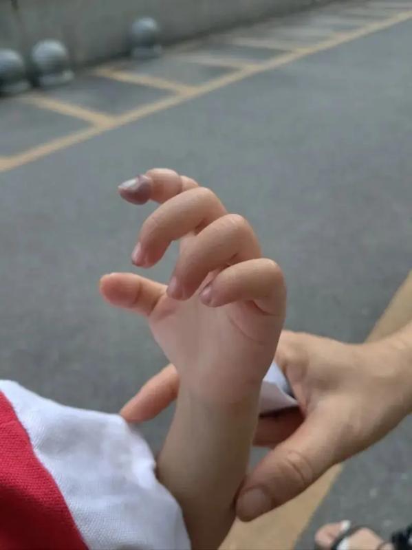Tỉnh dậy sau giấc ngủ trưa, bé gái 2 tuổi khóc thét, cô giáo nhìn thấy tưởng không sao, cha mẹ lập tức đưa đi viện- Ảnh 2.