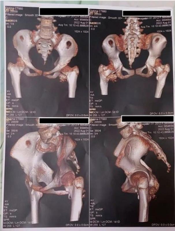 Bé gái 12 tuổi mắc "hội chứng người hóa đá hiếm gặp", bố mẹ ngỡ ngàng khi bác sĩ nhắc tới cú ngã xe đạp 2 năm trước - Ảnh 2.