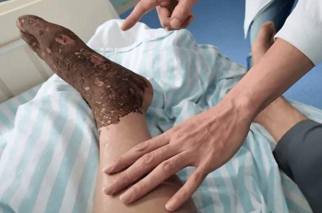 Bị rắn độc cắn khi đang cấy lúa, người đàn ông làm 1 việc khiến bác sĩ khen ngợi - Ảnh 1.