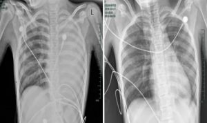 Cô bé 12 tuổi phổi trắng xóa và đông đặc sau 1 ngày bị sốt, bác sĩ cảnh báo: Đừng lúc nào cũng tưởng con cảm lạnh!