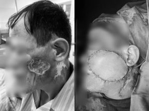 Bác sĩ Bệnh viện Bệnh Nhiệt đới Trung ương cảnh báo: Nốt nhỏ trên da có thể là ung thư, người đàn ông này đã phải cắt bỏ xương, chấp nhận biến dạng mặt
