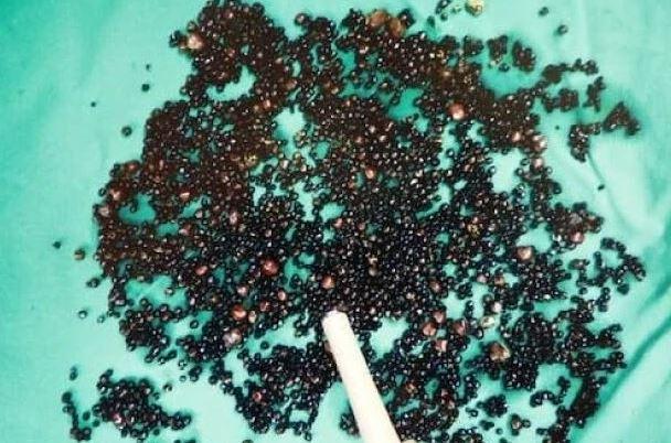 Đau bụng suốt nhiều tháng, người đàn ông 43 tuổi sốc nặng khi bác sĩ gắp ra thứ "đáng sợ" trong bụng - Ảnh 1.