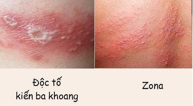 Bác sĩ BV Bạch Mai cảnh báo căn bệnh viêm da do một loại côn trùng gây ra: Cực độc, rất dễ nhầm lẫn với bệnh Zona và gặp nhiều vào mùa hè - Ảnh 2.